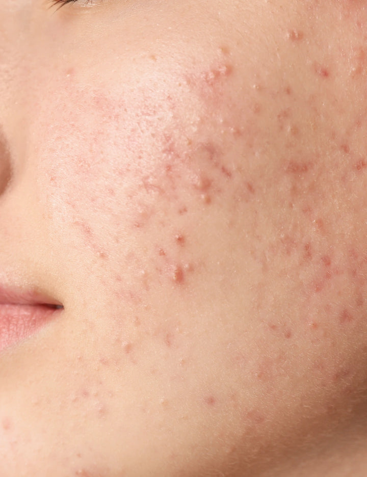 Elimina los poros fácilmente con Sebiaclear Micro-Peel 150ml