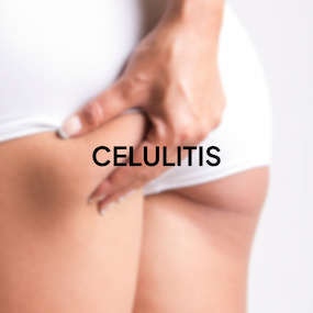 Persona con Celulitis