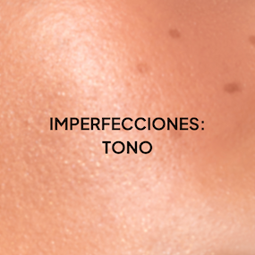 Imperfecciones en la Piel por Manchas Solares